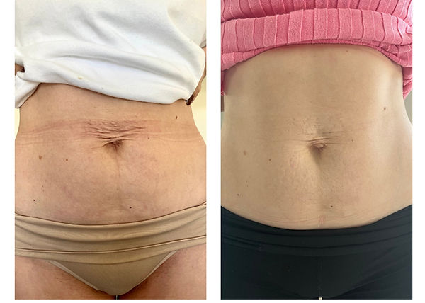 Non-surgical tummy lift