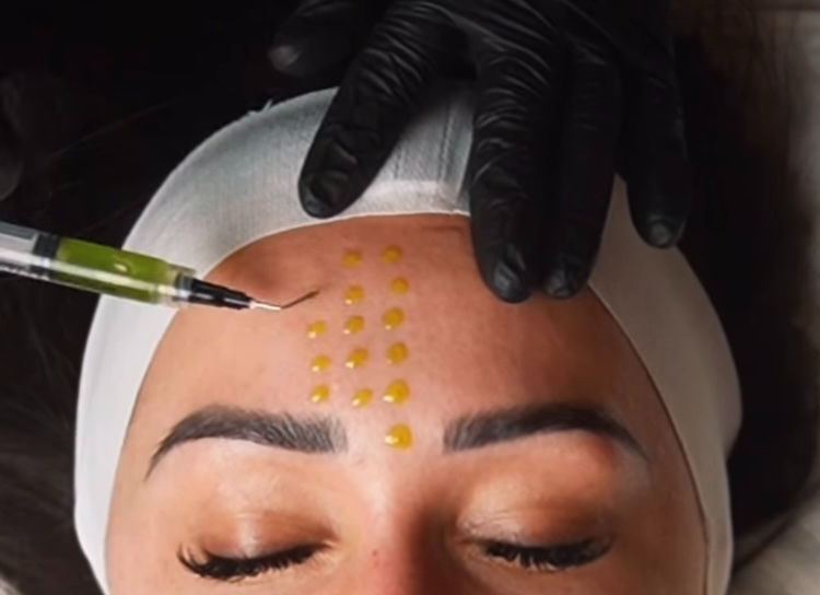 BioRePeel Newcastle: The Zero-Downtime Peel Everyone’s Talking About