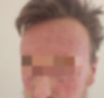 warm plasma resurfacing sun damaged face