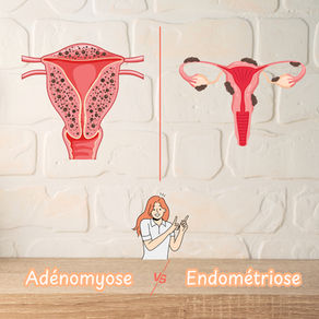 Adénomyose et endométriose — deux maladies différentes, mais souvent confondues