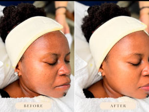HydraFacial Results Kampala