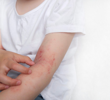 Red eczema rash on child’s arm, used to represent pediatric dermatology care