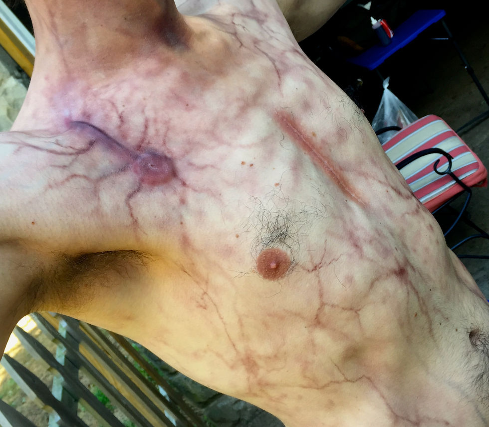 Veining and Prosthetics