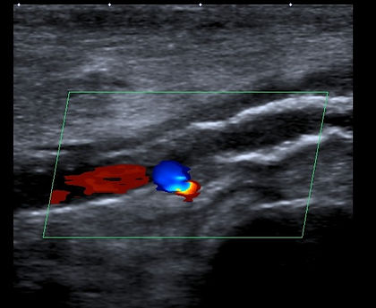 occluded artery with collateral redirecting flow