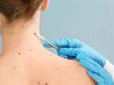 Impulsar autocuidado y políticas de salud para prevenir el cáncer de piel