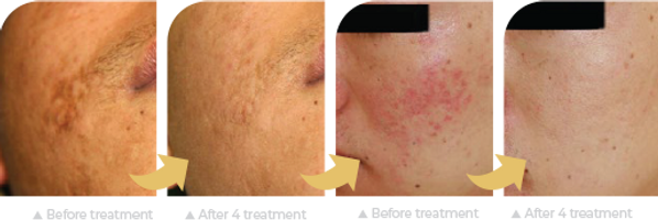 Clinical_Acne Scar.png