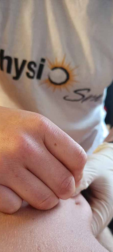 Dry Needling – Traitement des trigger points