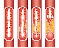 hypercholesterolemie-definition-fi.jpg