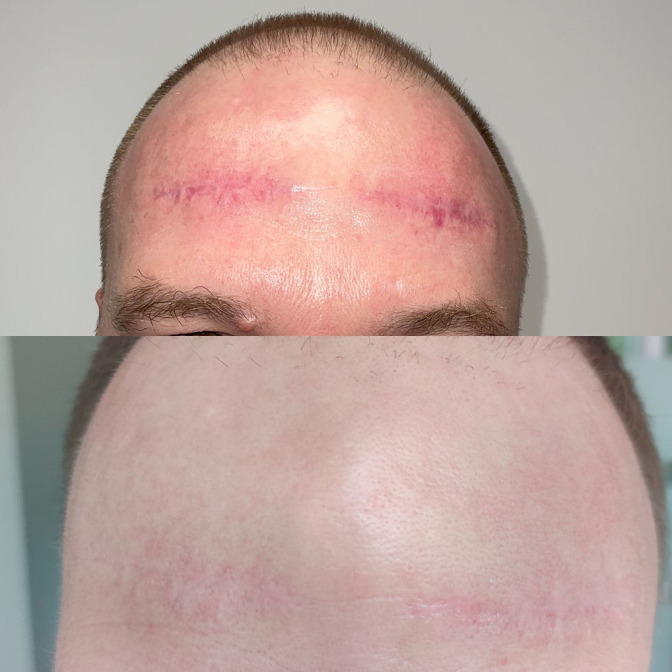 Seitliche Ansicht einer Haut mit Narben vor und nach Laserbehandlung