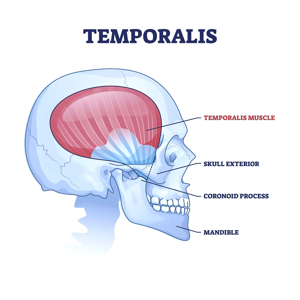 This is a graphic designed image showing a skull and the temporalis muscle. The temporalis muscle cause TMJ pain, jaw pain, and even referred teeth pain.