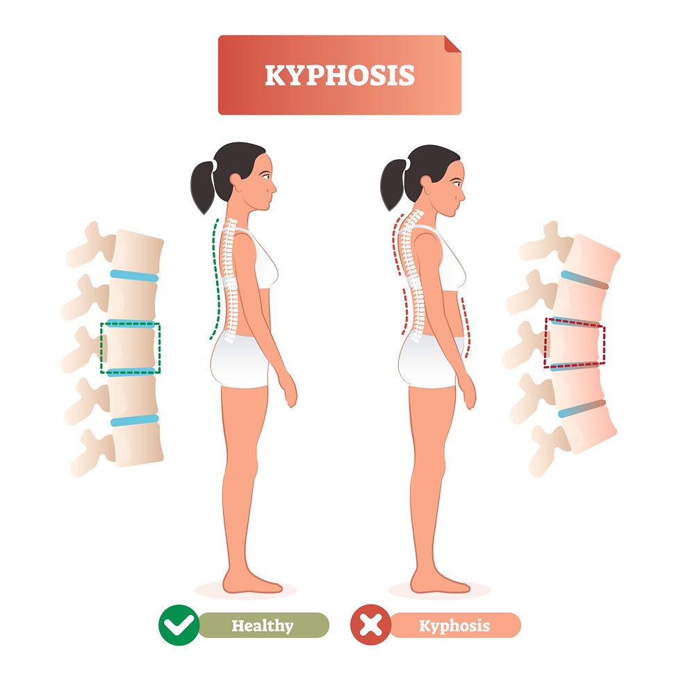 This graphic designed image shows a woman with a healthy thoracic spine and an unhealthy one. Kyphosis can be caused by changes on the cervical spine due to chronic coughing.