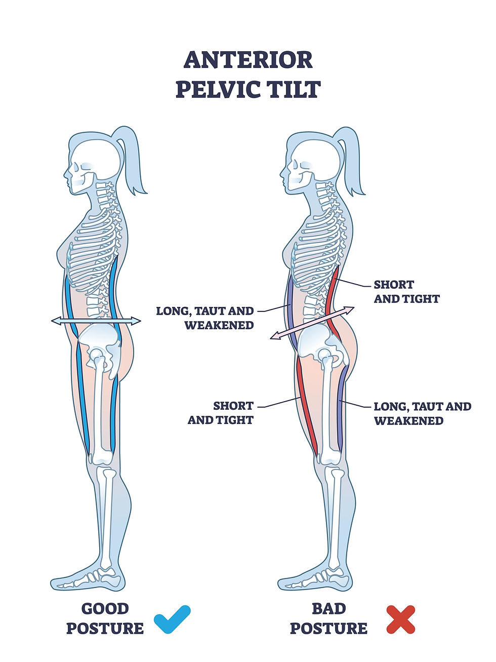 This is a graphic designed image of a woman outline, showing the skeleton, standing with a neutral pelvis and an anterior pelvic tilt.