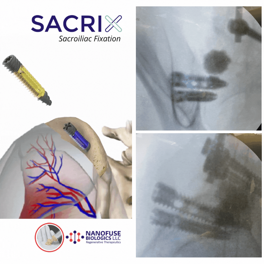 Sacrix+and+sacroplasty+2+gif.gif