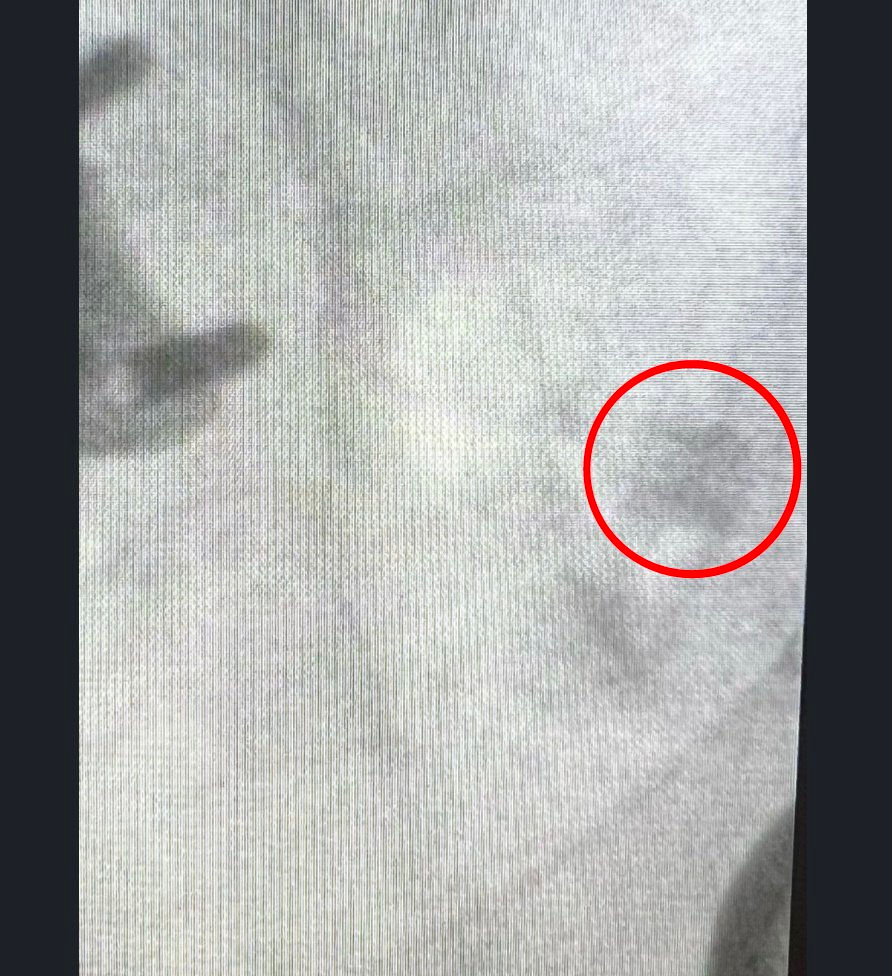 Posterior sacroiliac joint distraction with an allograft placed through the articular surface