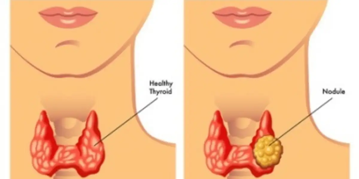 Is thyroid curable?