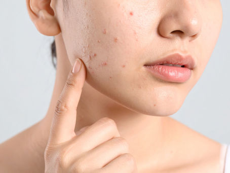 Hormonal Acne: Causes & Solutions