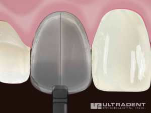 Thumbnail: Uveneer ultradent