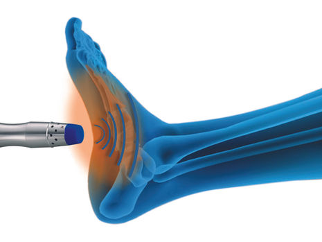Now Available at Balance Podiatry, Rockville Centre: Shockwave