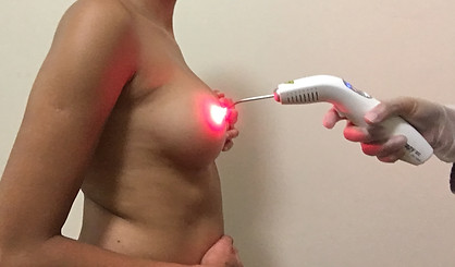 Laserterapia mamilos