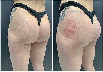 buttock filler