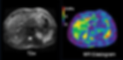 Liver elastography MRE fibrosis