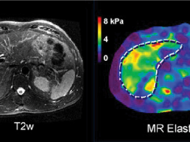 Mayo-backed Resoundant gains traction with tool to diagnose liver disease
