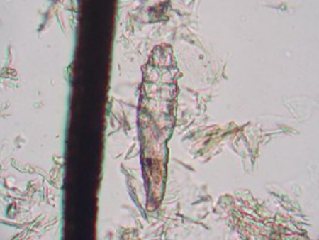 דמודקס - (Demodex)