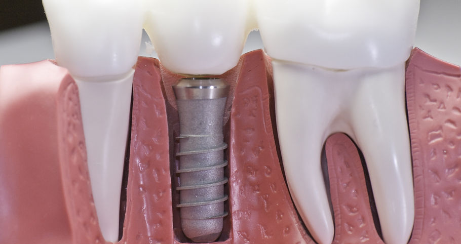 This model shows that teeth have been ca