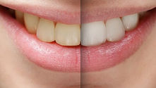 Whitening: 5 Things to Know Before Getting a Brighter Smile