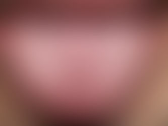 Τι δείχνει το χρώμα της γλώσσας για την υγεία σας