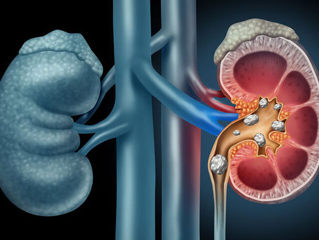 Πέτρες στα νεφρά: Ποια είναι η αποτελεσματικότερη θεραπευτική μέθοδος;