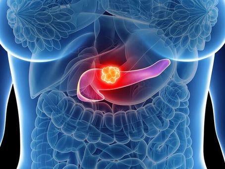 Καρκίνος στο πάγκρεας: Ο ρόλος του βάρους και οι επικίνδυνες ηλικίες
