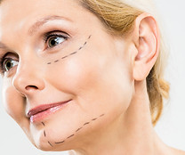 face lift.jpg