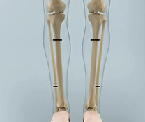 Leg-Lengthening-Treatment.jpg