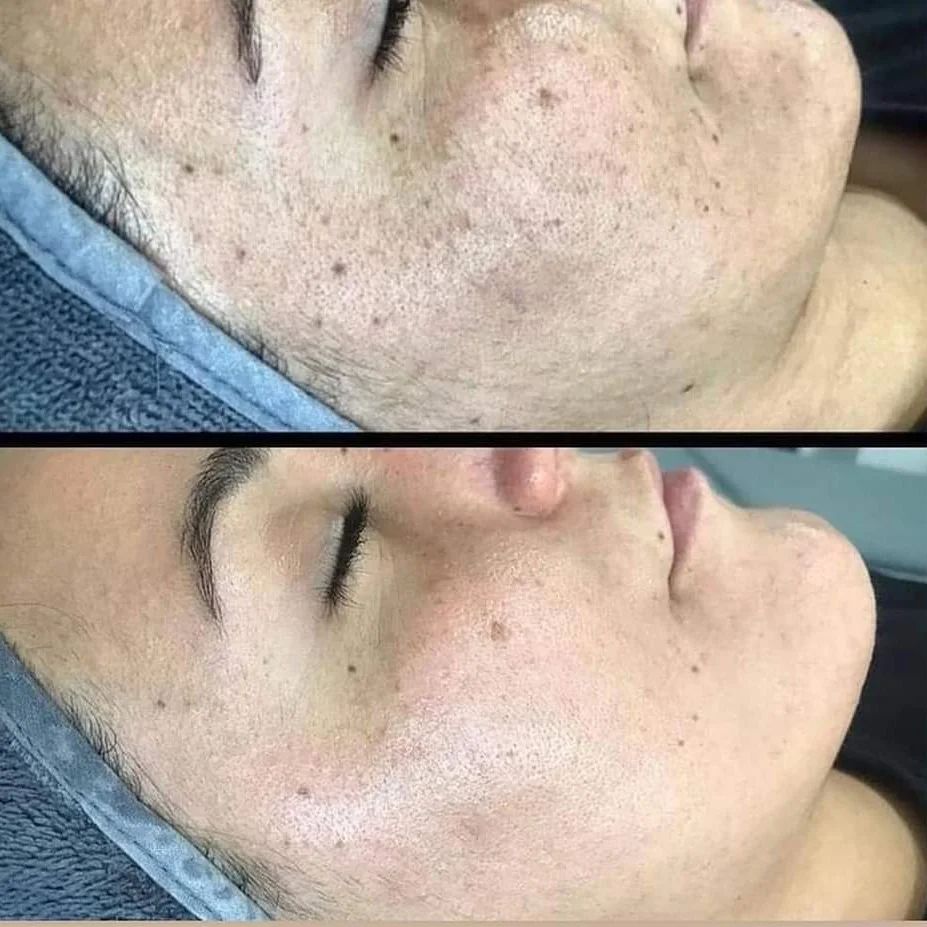 trattamento macchie toskani prima e dopo