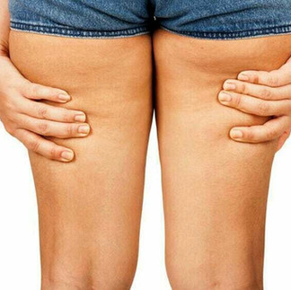 cellulite e ristagno nei tessuti, blocco del drenaggio e circolazione rallentata