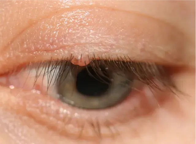 Grains de beauté (Naevus)