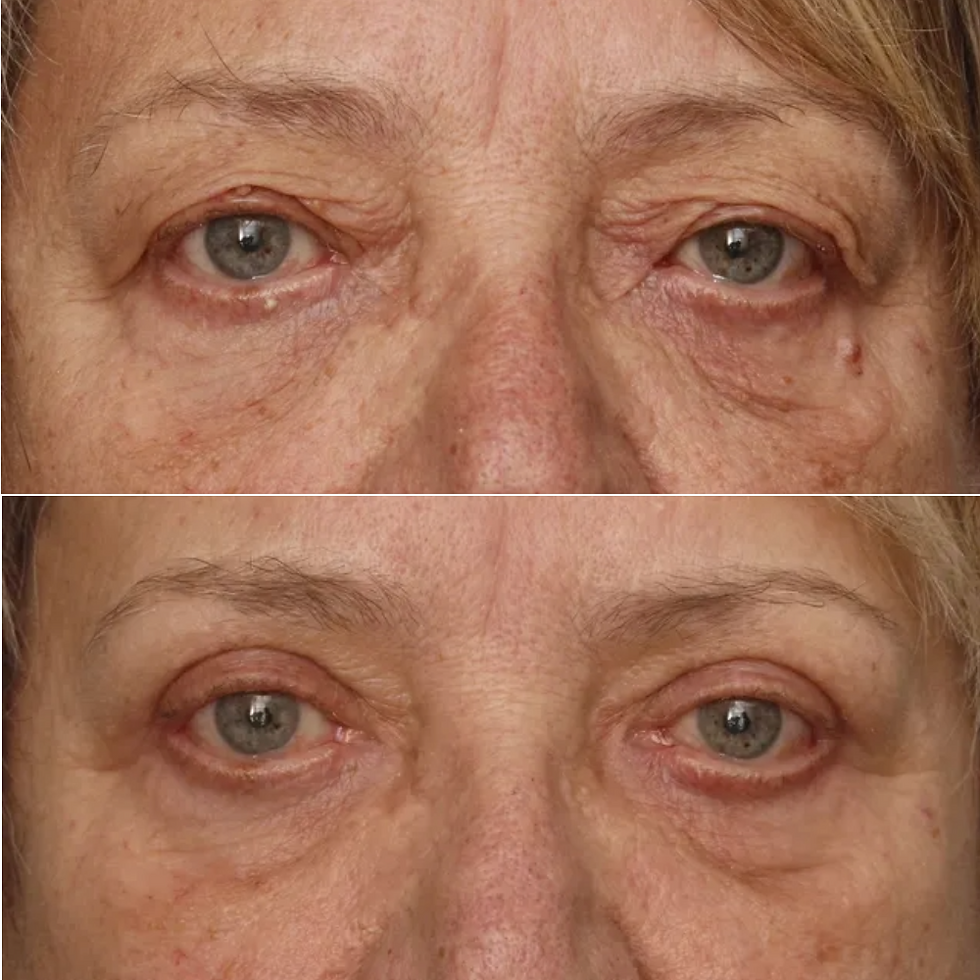 Chirurgie des 4 paupières