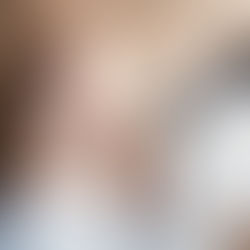 Microneedling et PRP : le guide complet pour comprendre ce duo qui fait sensation