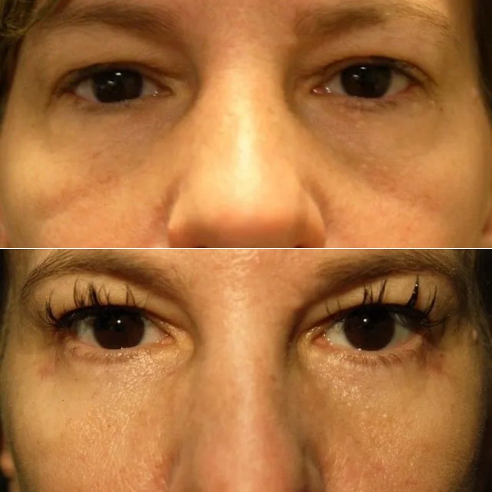 Chirurgie des paupieres inferieures