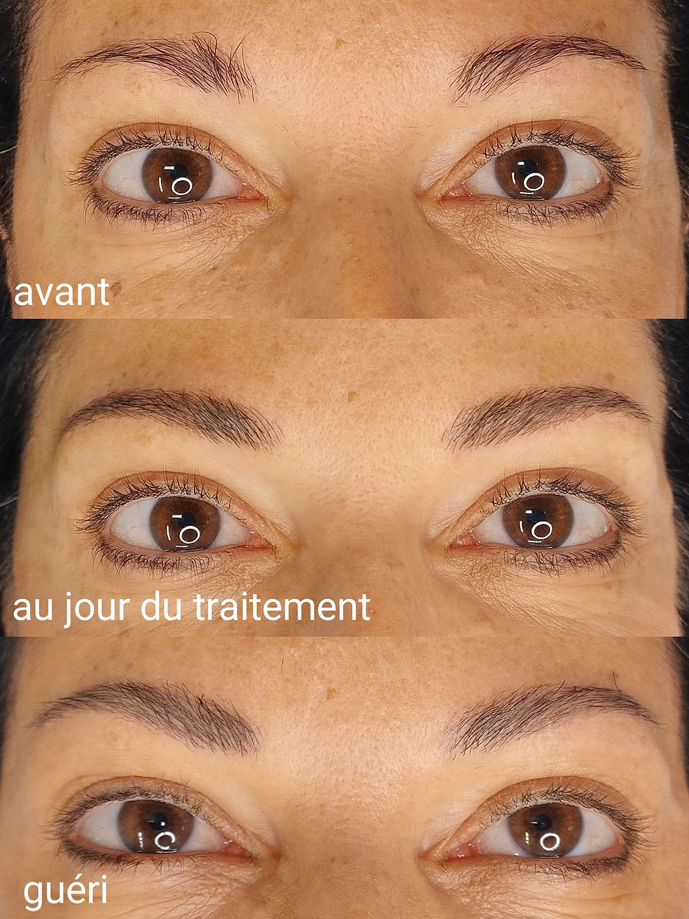 AVANT / APRÈS IMMÉDIAT / GUÉRI