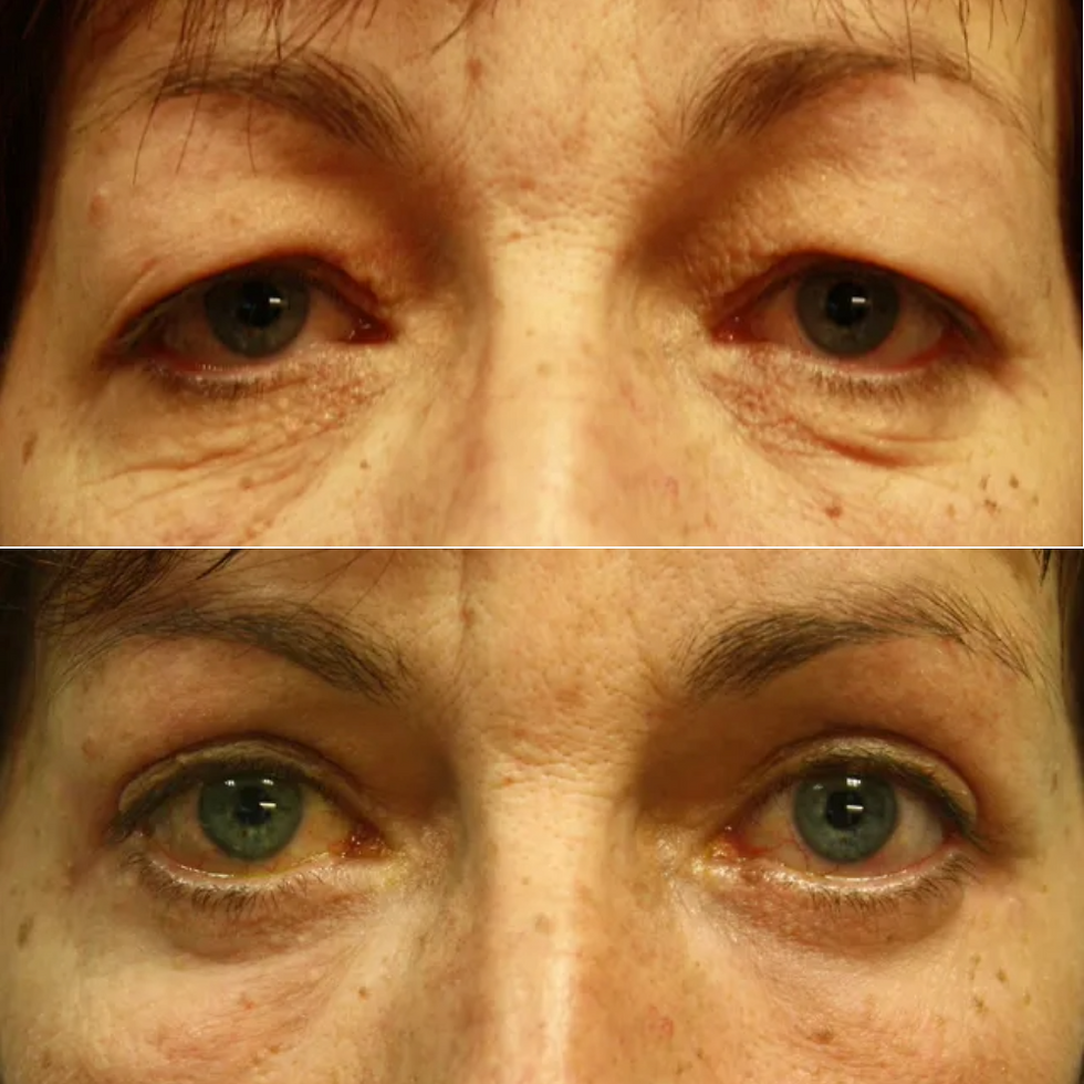 Chirurgie des 4 paupières