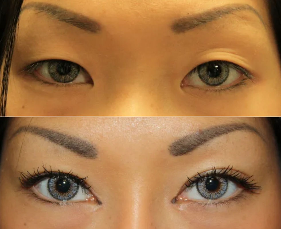 Chirurgie des paupieres asiatiques