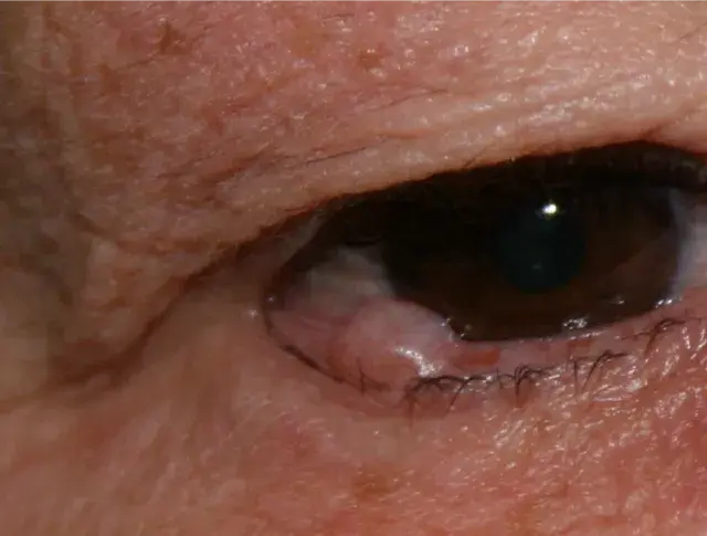 Grains de beauté (Naevus)