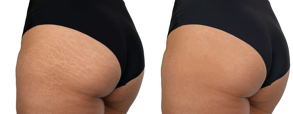 Thumbnail: Scar Revision & Stretch Mark Camouflage