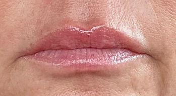 lips filler.jpg