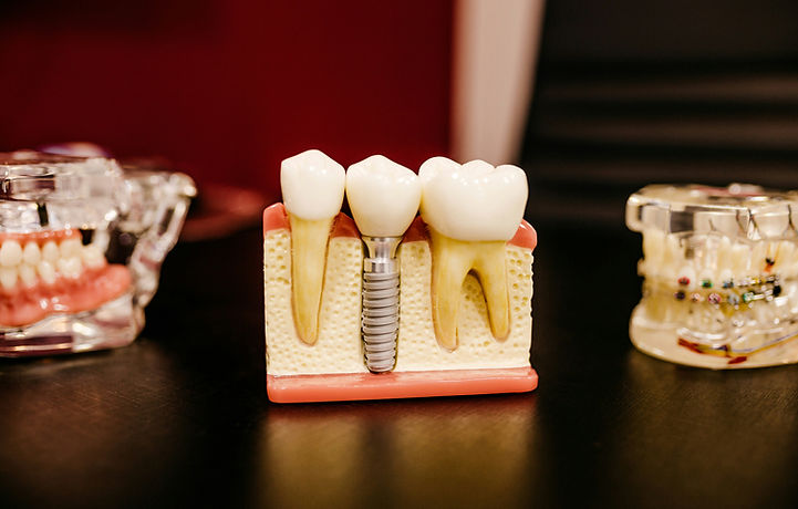 implant model