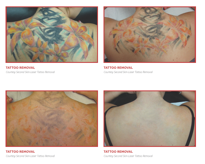 Tattoo Removal