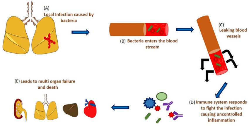 Fig1. Schematic Representation of Sepsis