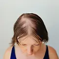 hair restoration.webp